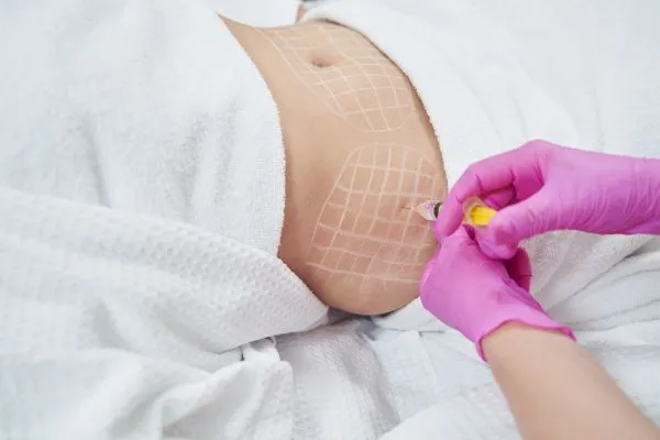 image of fat dissolving injections on love handles to help combat weight gain Thatcham