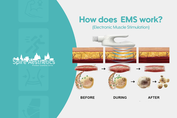 EMS treatment for post pregnancy weight loss treatment Thatcham
