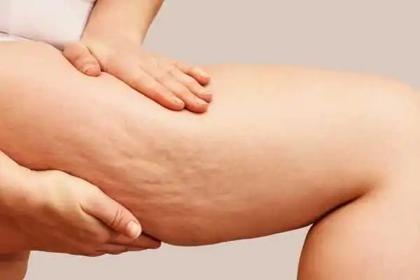 Image of woman showing leg with cellulite Thatcham