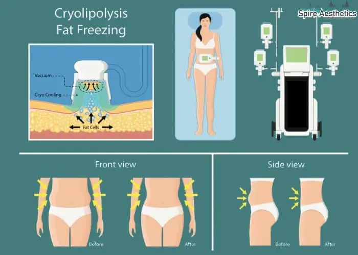 Fat freezing treatment Thatcham benefits for competitions to remove stubborn fat deposits.