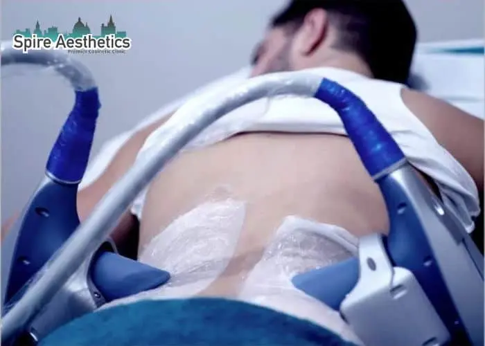 Man having fat freezing treatment done on love handles before a competitions Thatcham to create a sculpted look.