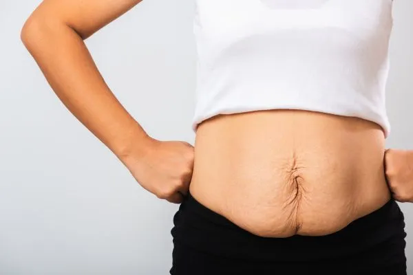 Image of a woman's stomach after weight loss with sagging skin following a gastric band Thatcham