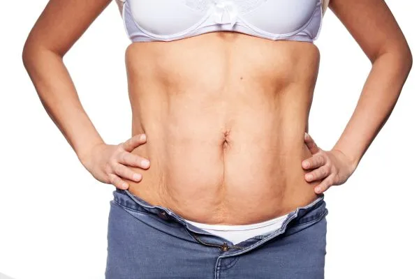 sagging skin on woman's stomach after weight loss injections Thatcham