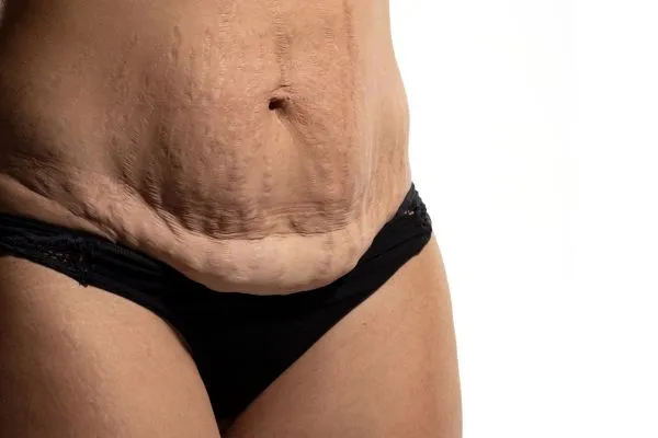 Image of womans stomach after weight loss injections Thatcham showing saggy skin