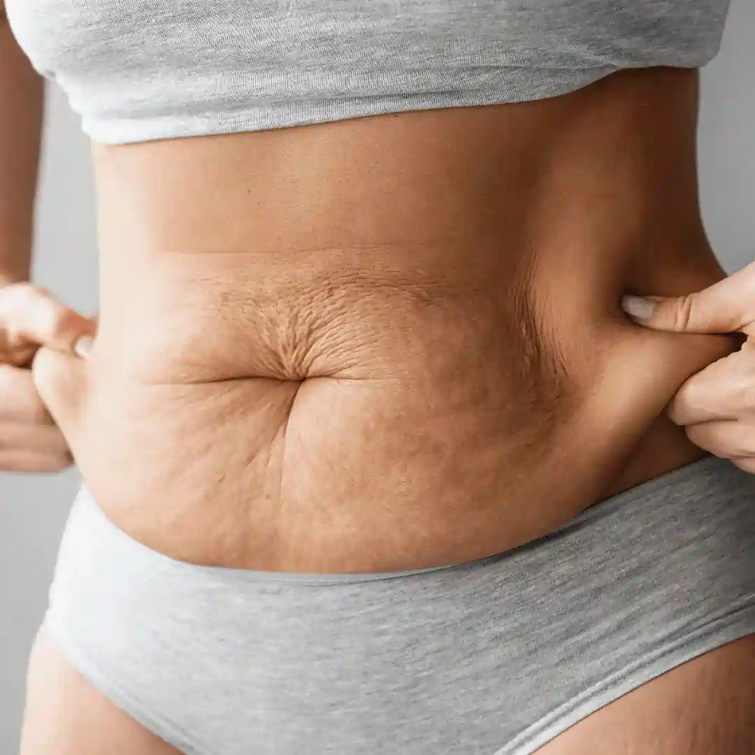 Is It Normal to Have Loose Skin After Pregnancy Thatcham?