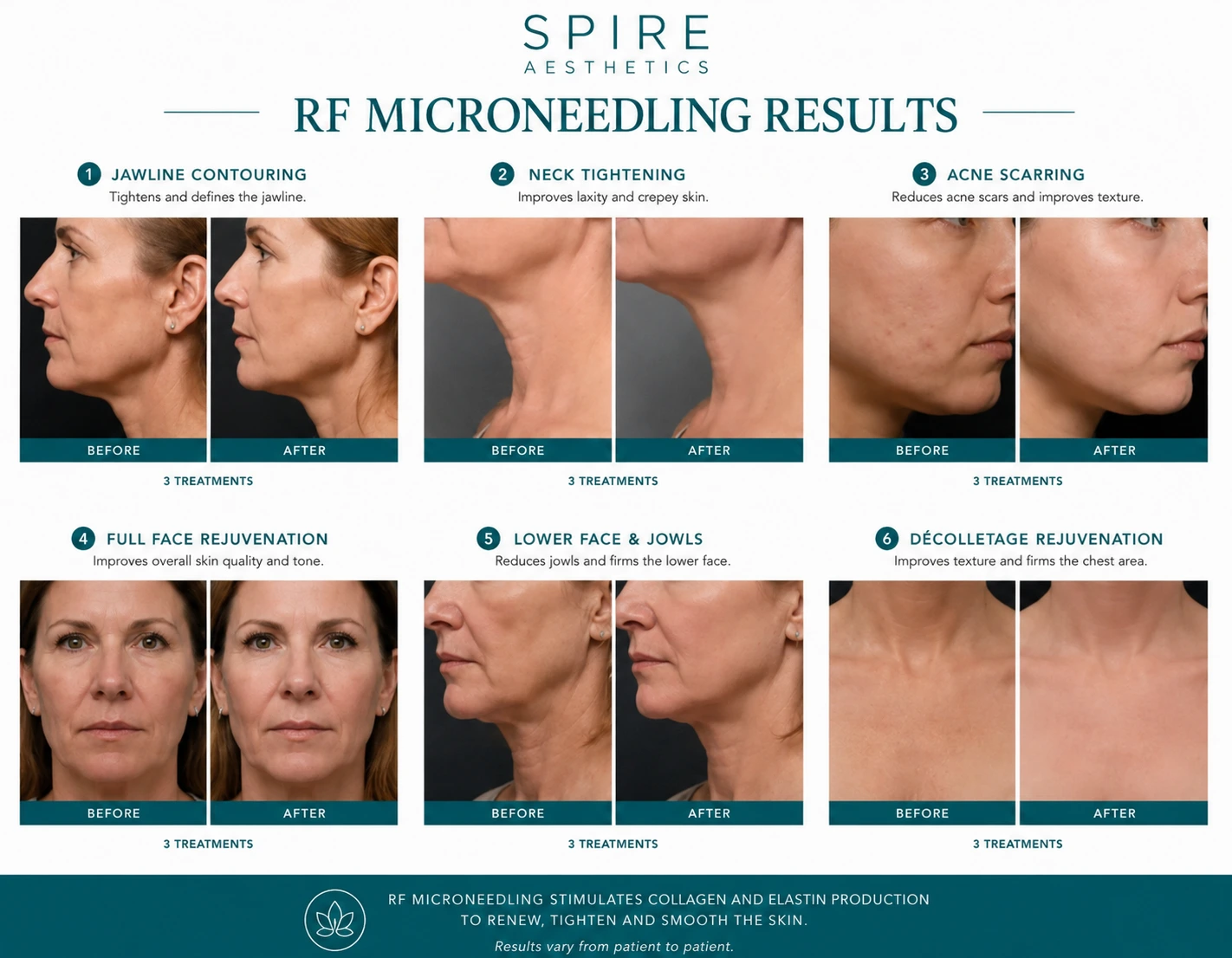 RF Microneedling Skin tightening Thatcham results
