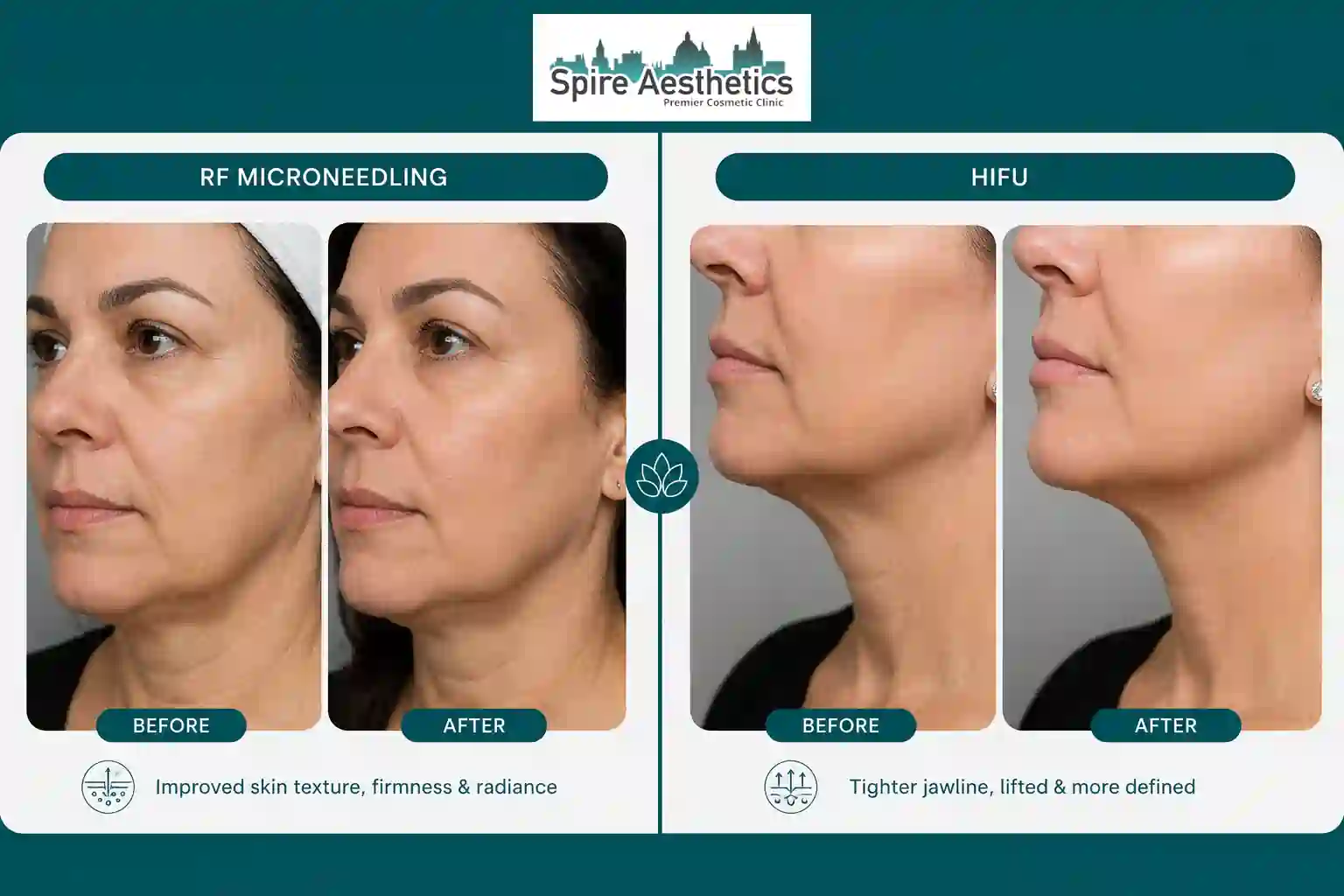Can RF Microneedling and HIFU Be Combined Thatcham?