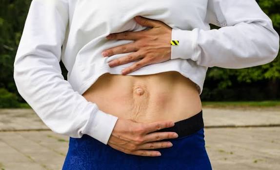 When Could Diastasis Recti Be the Missing Piece of the Puzzle Thatcham?
