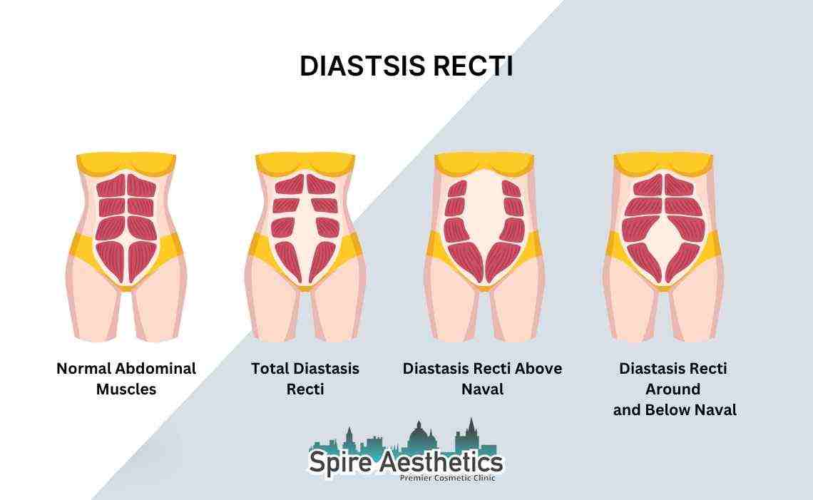 Is Non-Surgical Diastasis Recti Treatment Right for You? Common Concerns Answered Thatcham